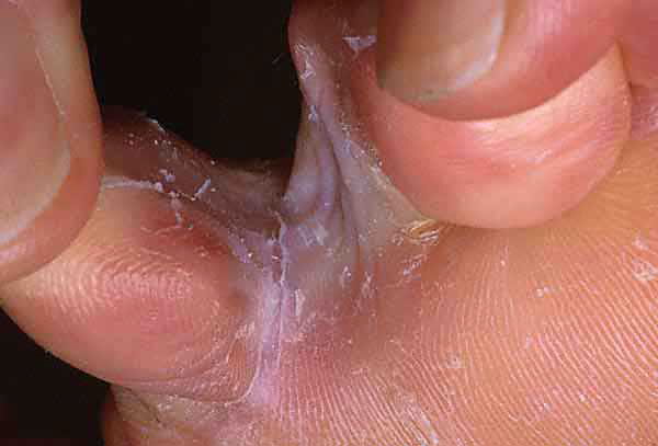 BioSpray Athlete's Foot Outbreak Control